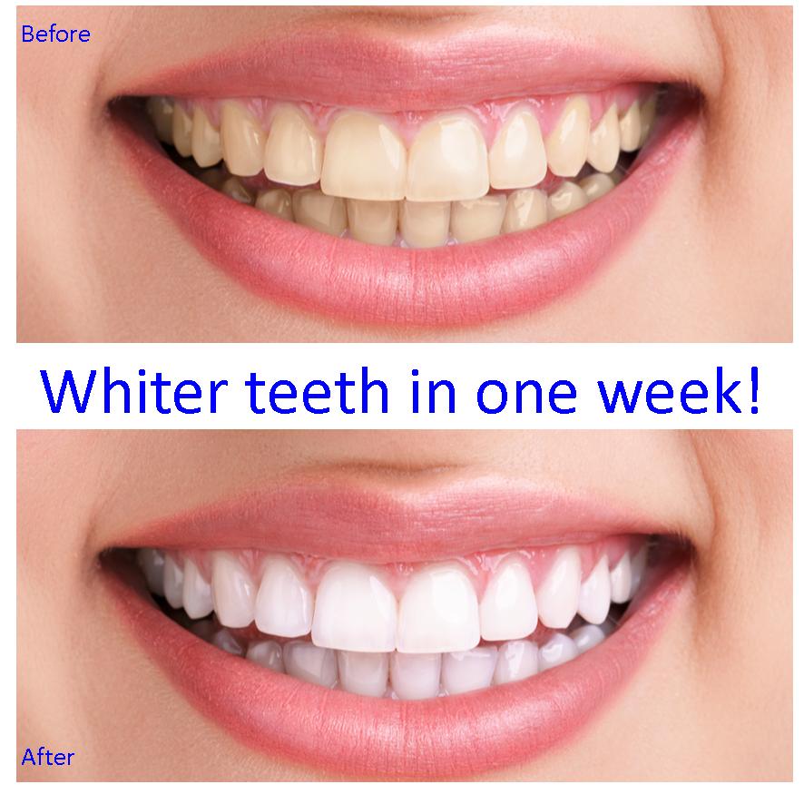 PAP Teeth Whitening Strips 7 Pairs. Processional Dental Whitening Bleach
