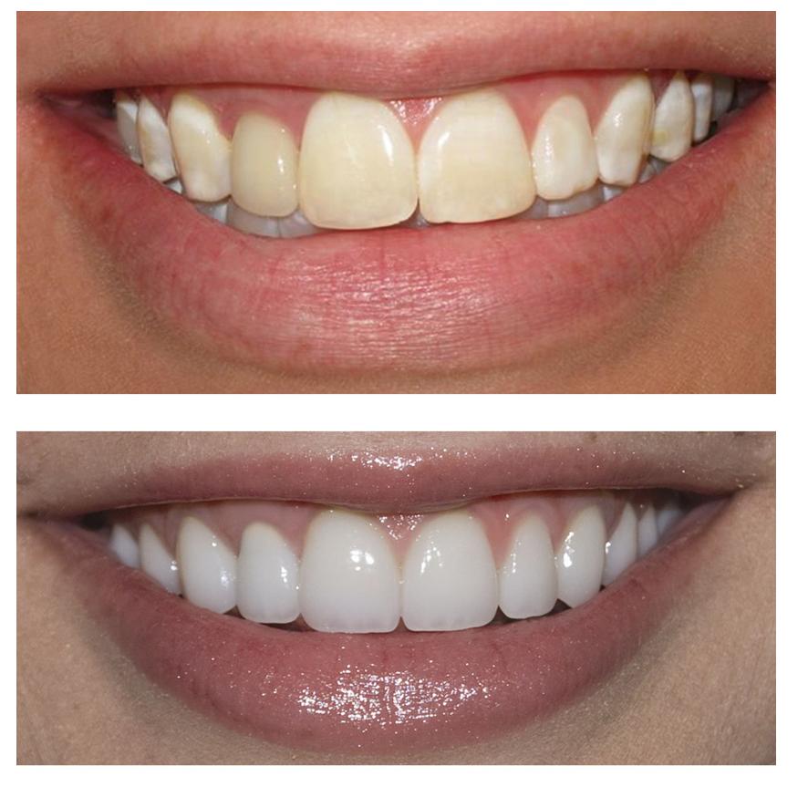 Teeth Whitening Gel 3ml each, Refill Gels Bleach fast effective whitener for excellent results