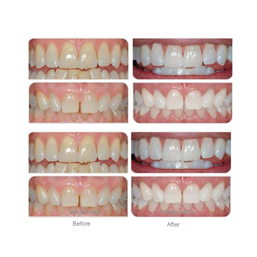 Teeth Whitening Gel 3ml each, Refill Gels Bleach fast effective whitener for excellent results