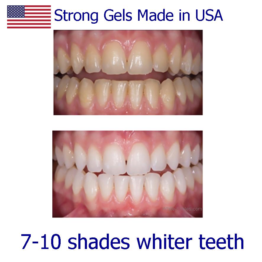 Teeth Whitening Refill Gel 10ml Made in USA, fast effective whitening