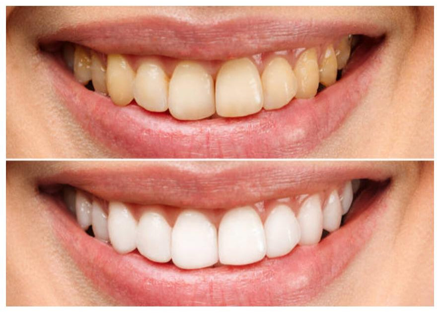 Before and After