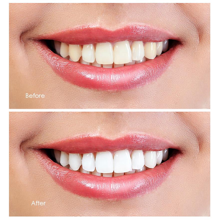 Teeth Whitening Refill Gel 10ml, Made in Italy