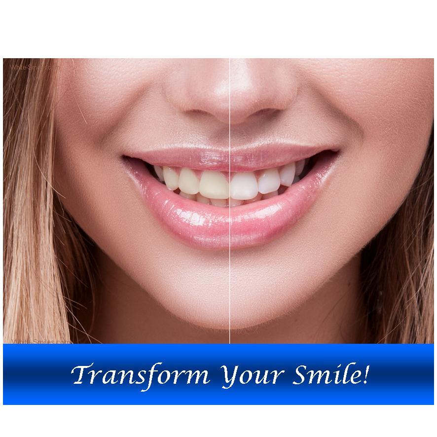 Teeth whitening gel