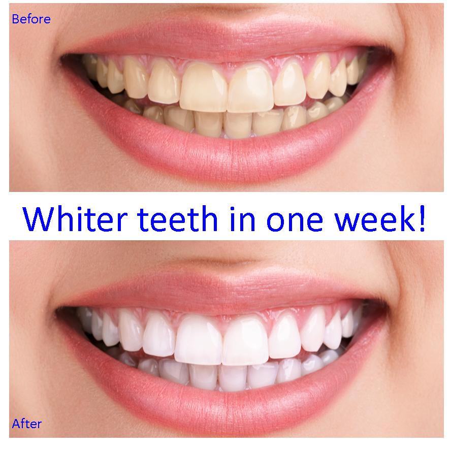 TEETH WHITENING KIT