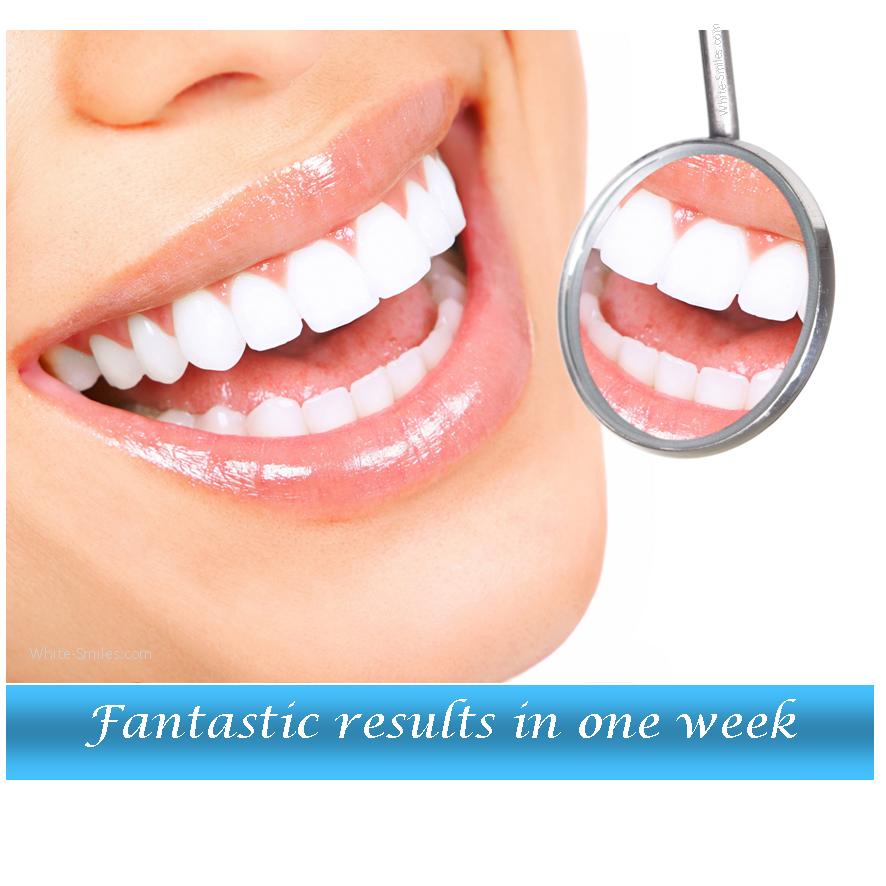 Teeth whitening gel